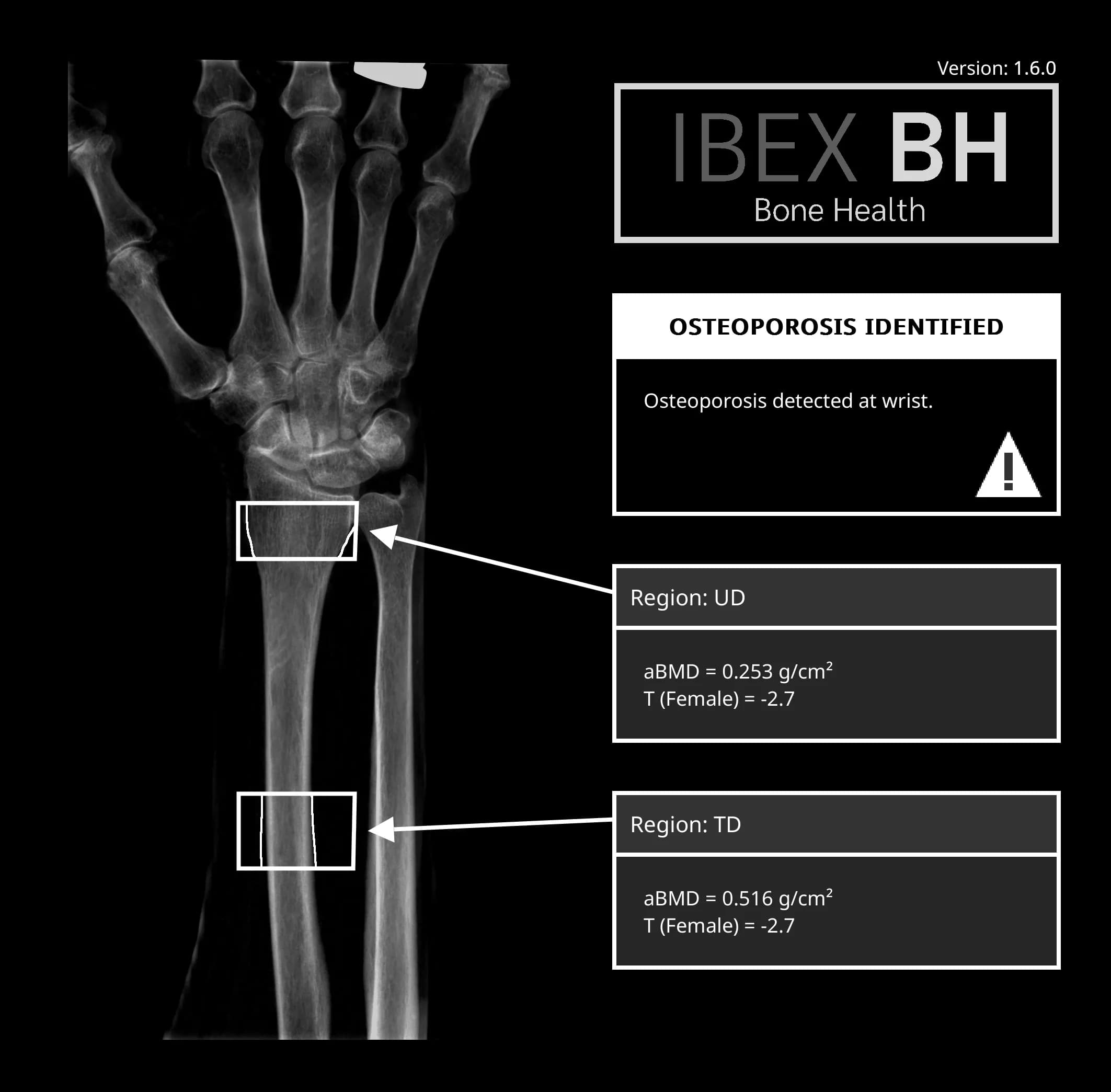AI-Powered Bone Health Tech from County Durham Offers Lifesaving Potential for NHS
